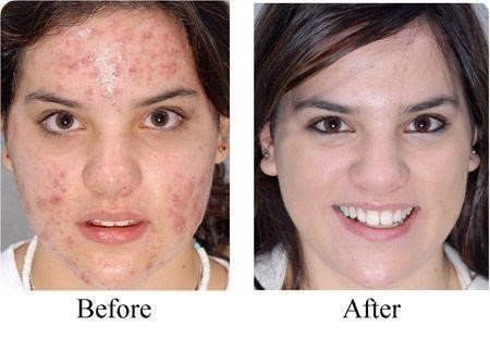 cure acne fast